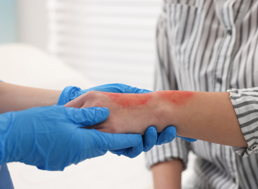 Skin burning after corticosteroids: how to recognize and relieve this little-known syndrome?