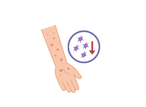 Immune thrombocytopenic purpura (ITP): symptoms, diagnosis, and treatments