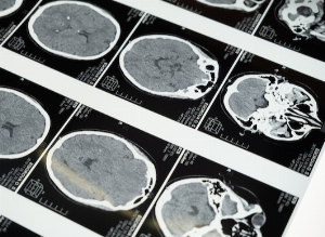 Neurodegenerative diseases: what are they, and what are their first signs?