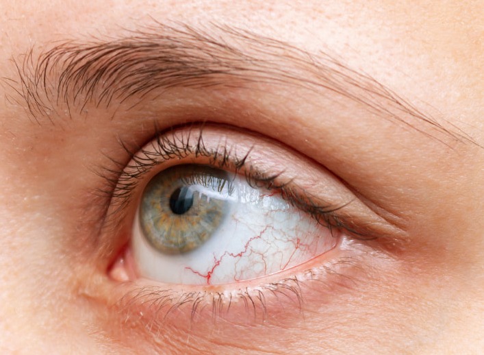 What is the link between chronic inflammatory bowel disease (IBD) and eye disorders?